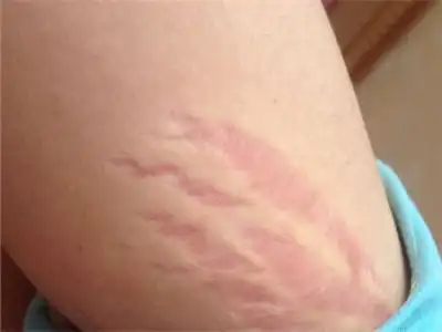 紫纹怎么消除了解种类快速解决