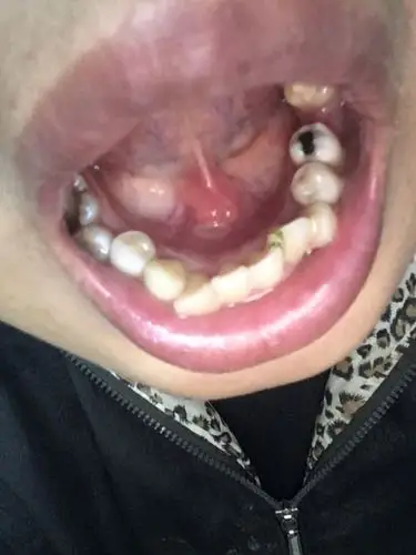 舌头下面有一个白色的是什么