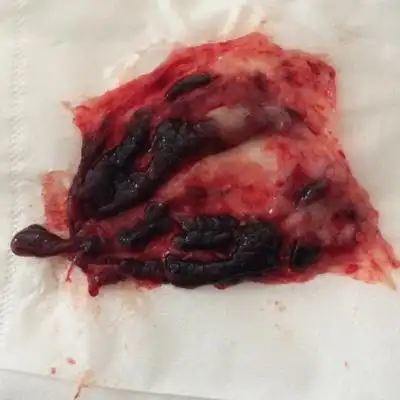 这个胎囊能看出男孩女孩吗?