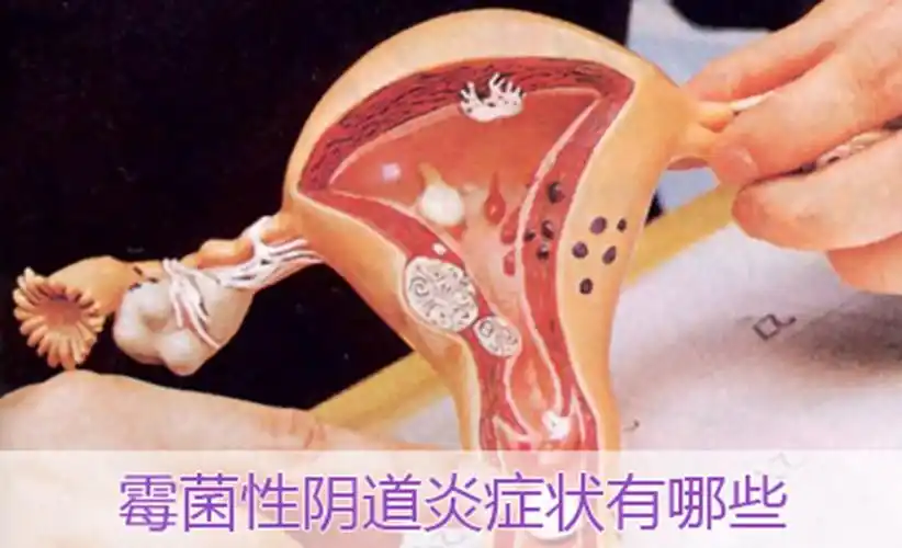 霉菌阴道炎有哪些症状图片