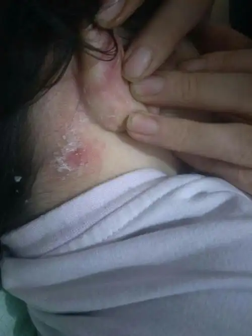 一岁半的宝宝,耳朵背后张的是是什么?求专家.皮肤病