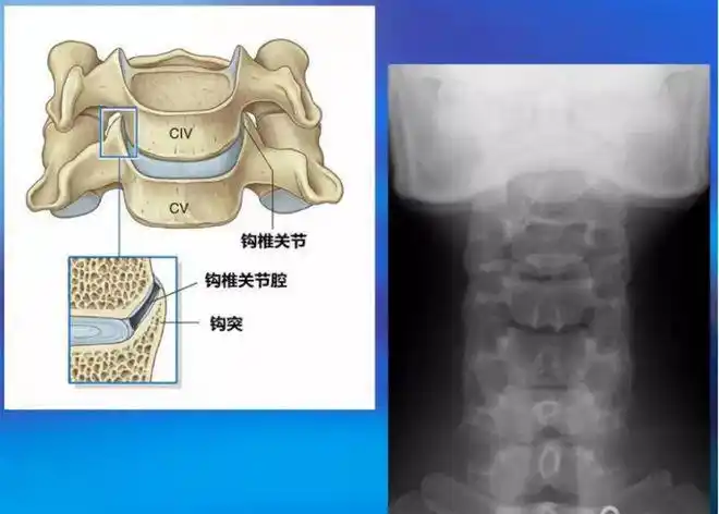 再来看一张颈椎正位片上的"钩突".