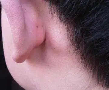 耳朵后面长了个疙瘩是怎么回事?医生说:要小心这几种情况!