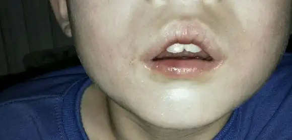 腺样体肥大医院济南哪家好?这就是腺样体面容吗?他的硬腭算高拱吗?