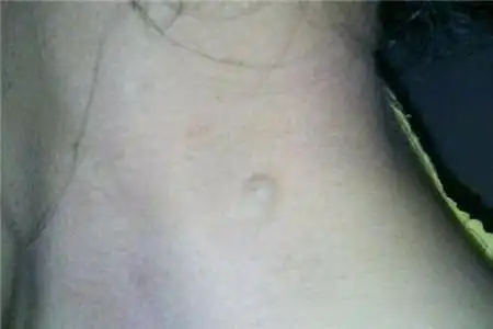 脂肪瘤形成的原因以及消除的方法