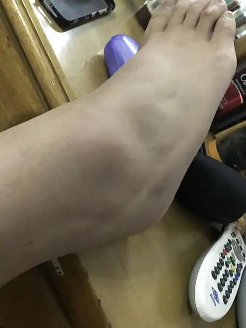 脚跳舞的时候扭了一下,明天还能继续跳舞吗?