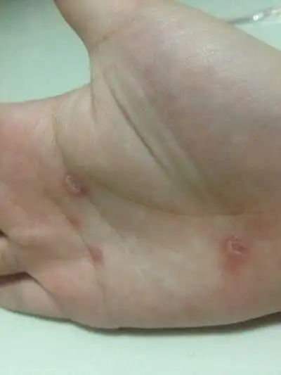 男性一期梅毒图片49