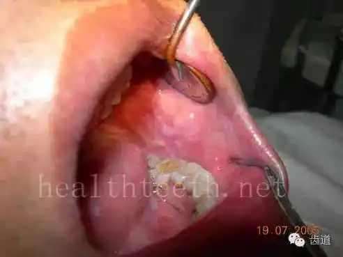 多图慎入简单明了通过图片让你的患者了解口腔常见疾病