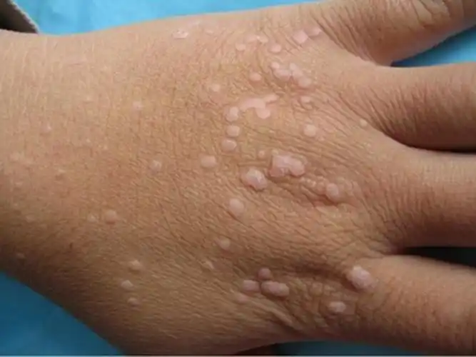 眼部皮肤丝状疣的图片