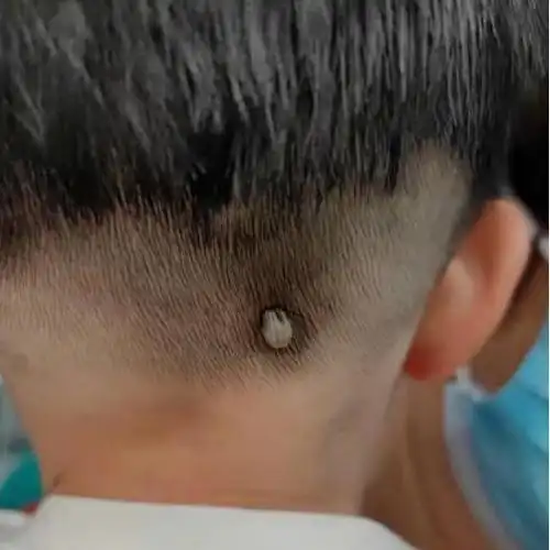 温州1岁男孩头上发现肉球还越变越大