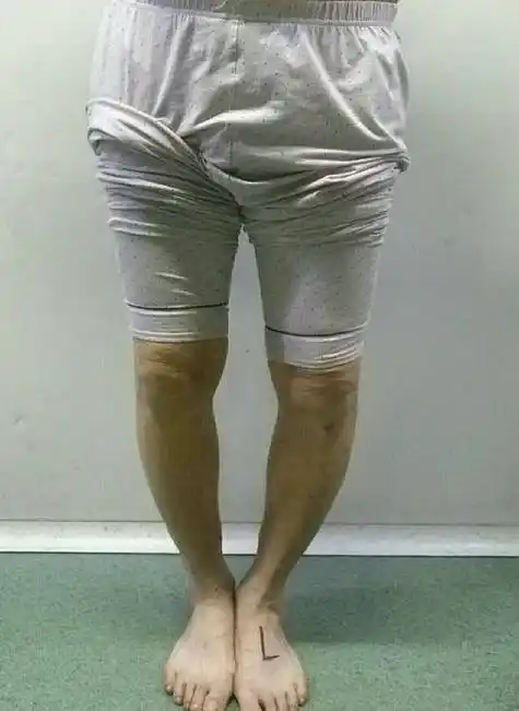 为什么"o型腿"更容易膝关节痛,罹患关节炎?