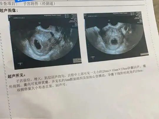 45天男孩胎囊图片