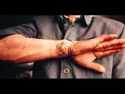 双下肢的皮肤结核病的图片