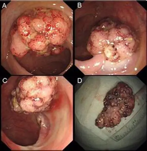 吴忠肠息肉专家_吴忠治疗肠息肉哪个专家好_吴忠治疗肠息肉最好的专家