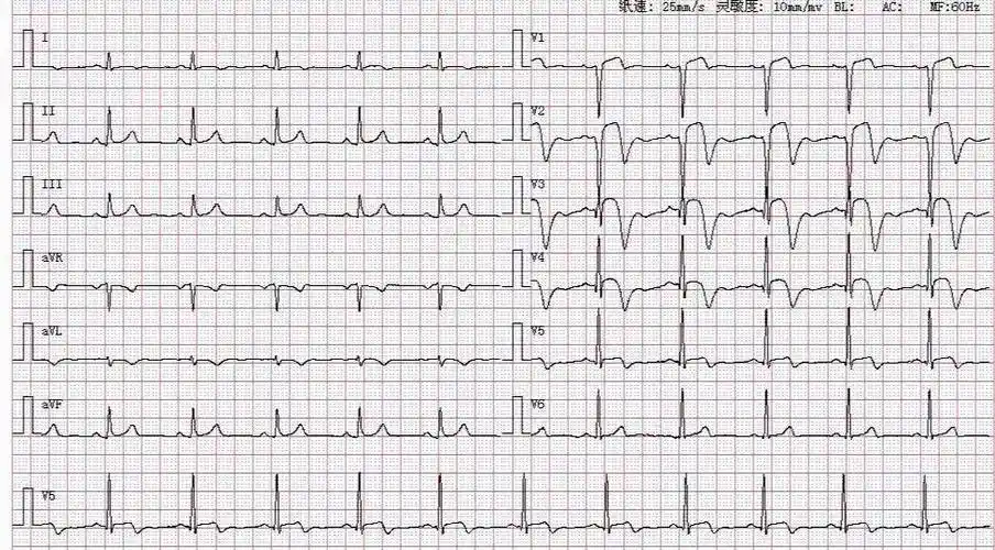 典型心电图急性心肌梗死没有基础也能一看就懂