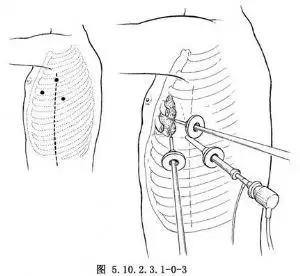 可以经胸腔镜进行肿物活检以明确诊断,也能完成某些肿瘤切除手术