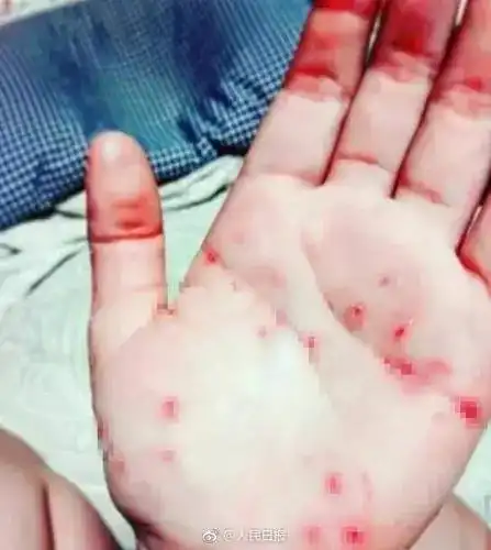 看着都痛!这种和"蓝鲸"一样危险的自残游戏,在青少年中偷偷传播