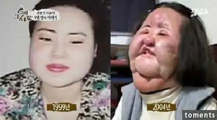 少女锯掉6根肋骨 扒全球整容失败者!恐怖慎看