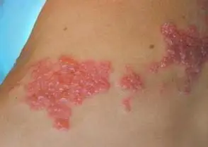 [转载]妙方治带状疱疹