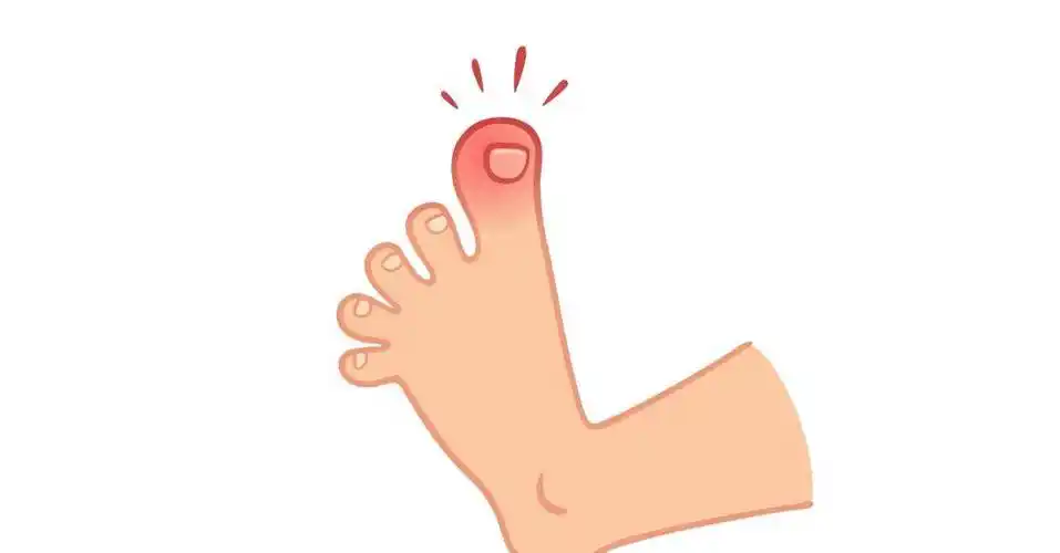 糖尿病患者若不想截肢,当足部发出这几个信号时,一定要警惕_手术_进行