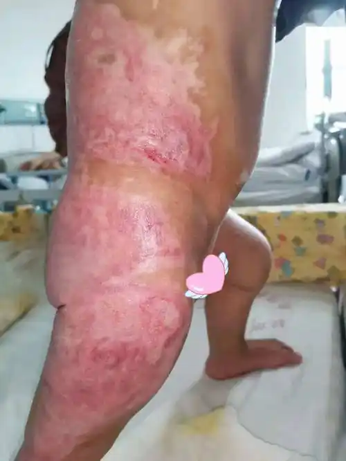 心疼!钦州一名2岁宝宝被热水严重烫伤,家长们一定要警惕_小宝_创面_小