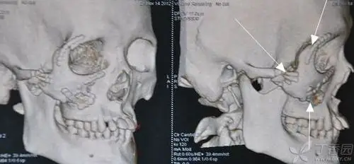 上颌骨骨折 [病例帖]
