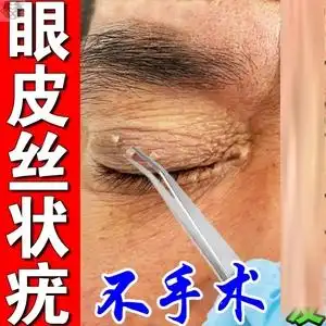 丝状疣眼皮扁平疣专用药膏去除面部猴子肉粒疙瘩颈部皮赘跖疣神器