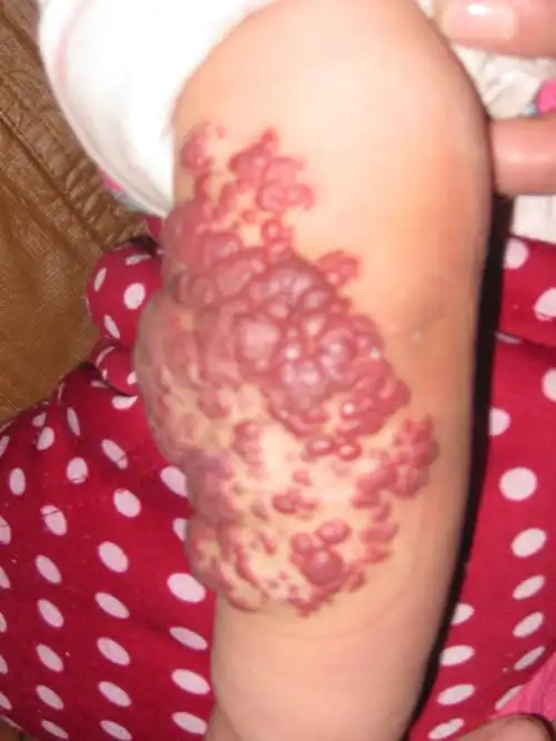 腿部血管瘤症状及危害,专家为您详情解读!