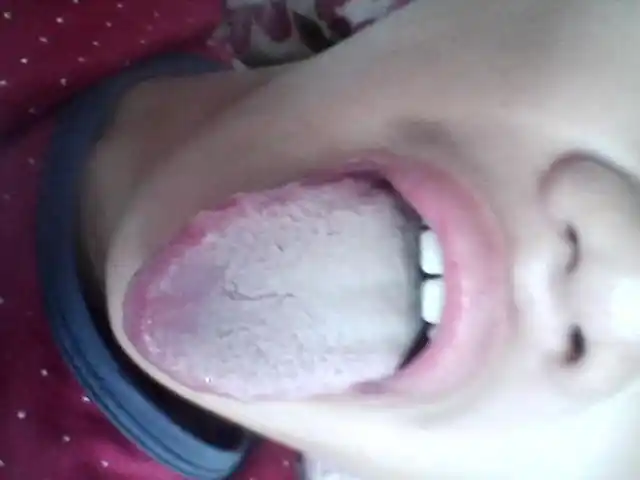 艾滋病初期症状图片