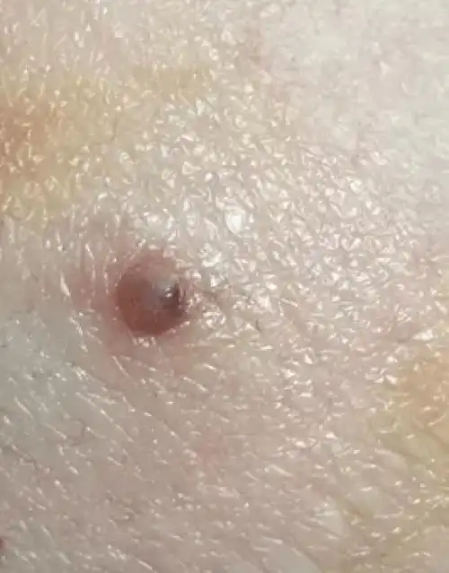 【提醒】医生看了一眼这个"痣",说是肝癌信号?快看看自己身上有没有!