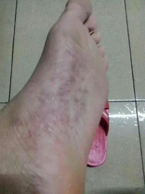 一开始就是几个小红点,现在这么多.奇痒难忍啊