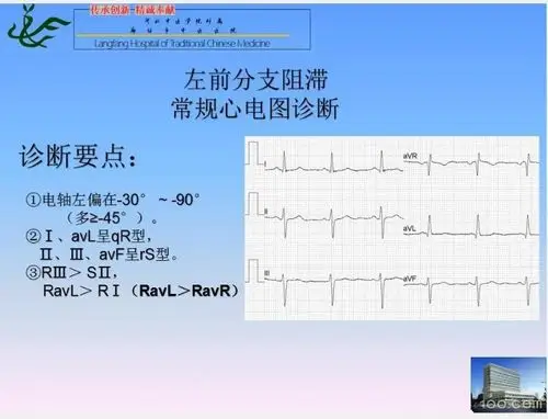 佟润国老师左前分支阻滞心电向量
