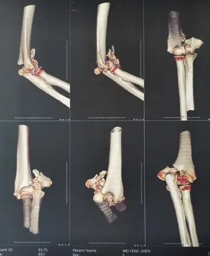 肱骨髁上粉碎性骨折,肱骨颈粉碎性骨折!