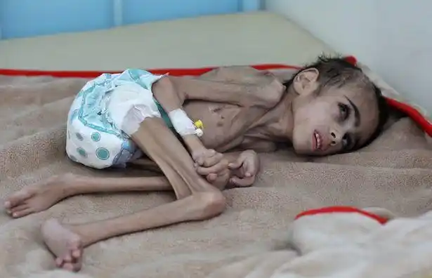 被遗忘的也门战争:7岁男孩遭饥饿蹂躏,体重不到14斤