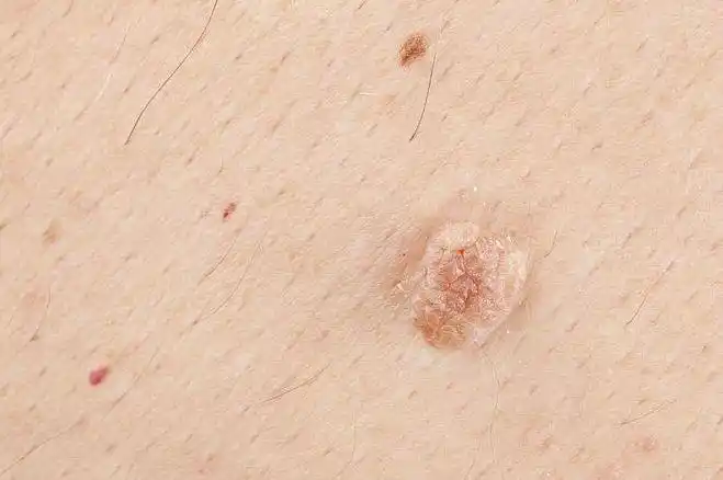 菜花病 (1)_有来医生