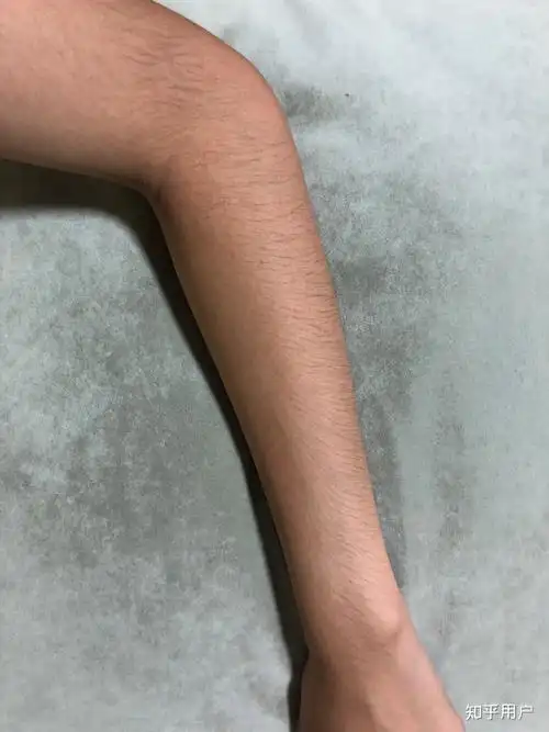 女生汗毛多怎么办
