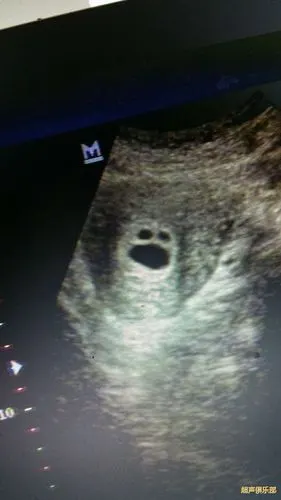 早孕患者,大的是孕囊,内看见卵黄囊