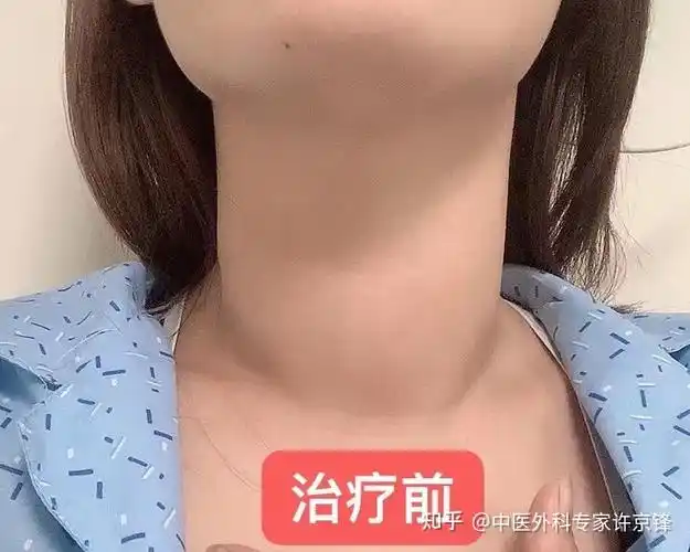 甲亢出现的大脖子恢复了钟女士少了份焦虑
