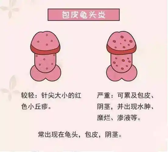 龟头炎是指男性龟头部因为刺激,外伤或感染等原因引起的黏膜炎症.