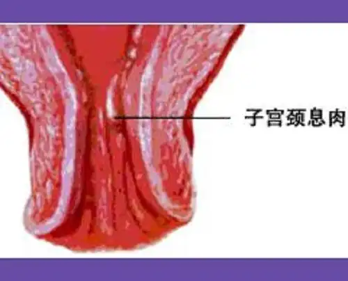 宫颈息肉容易发作的原因_读文解惑_相关hpv科普知识_盛华医药官网