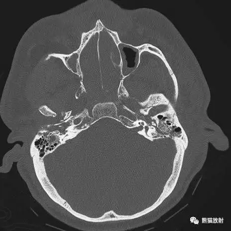 【急诊】颧骨骨折,上颌骨骨折ct表现
