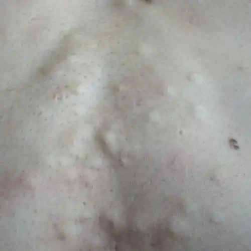 皮下脂肪瘤图片46