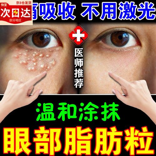 汗管瘤去除神器脂肪粒去除神器膏眼部专用油脂粒扁平疣白色颗粒男 单