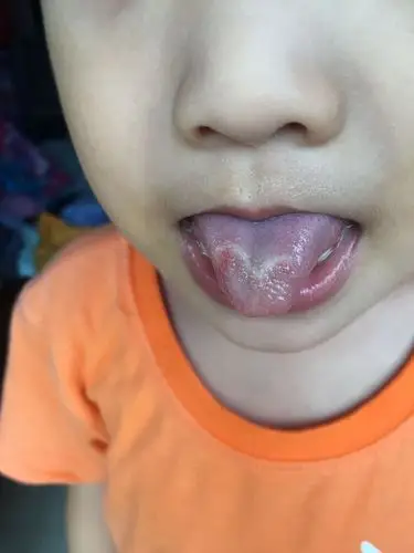 三岁宝宝舌头破