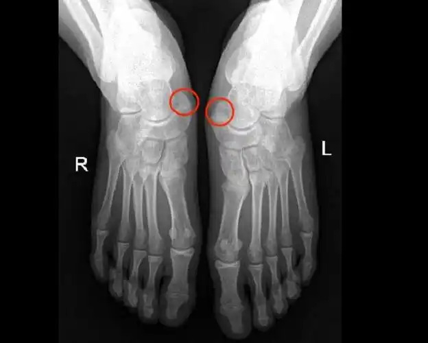 在湖南省人民医院儿童骨科被诊断为"双足副舟骨,双侧扁平足",经保守