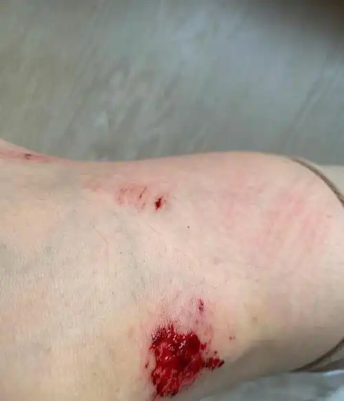 张静初因为路上突然冲出来的小动物,急刹车后连人带车摔倒,膝盖伤口最