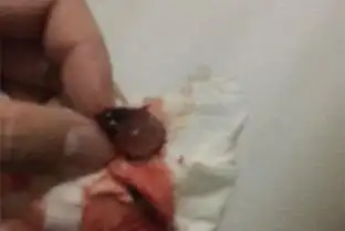 药流后胎囊40天排出图 - 搜狗图片搜索