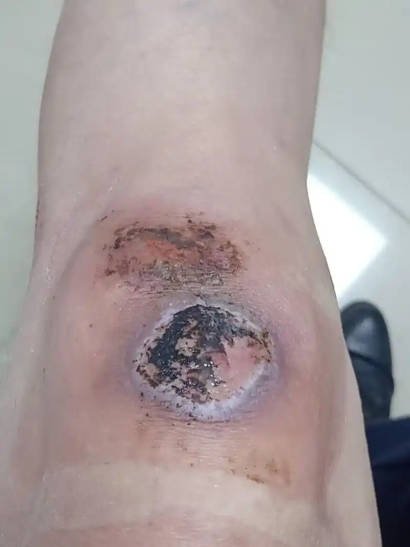 摔伤了摖啥药可以快速好起来呀 骑车滑倒了,就这样了,快半个月了,还不