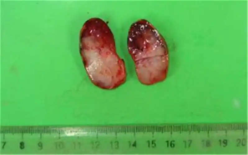 男性肉芽状假性湿疣图片_有来医生