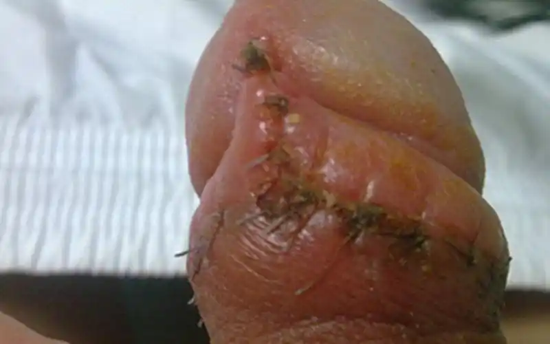 假尖锐湿疣白醋测试图片_有来医生